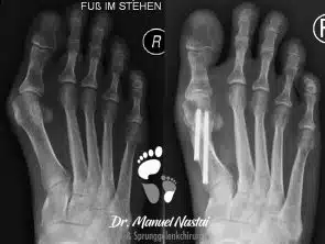 Röntgen-Aufnahme vorher-nachher bei MICA