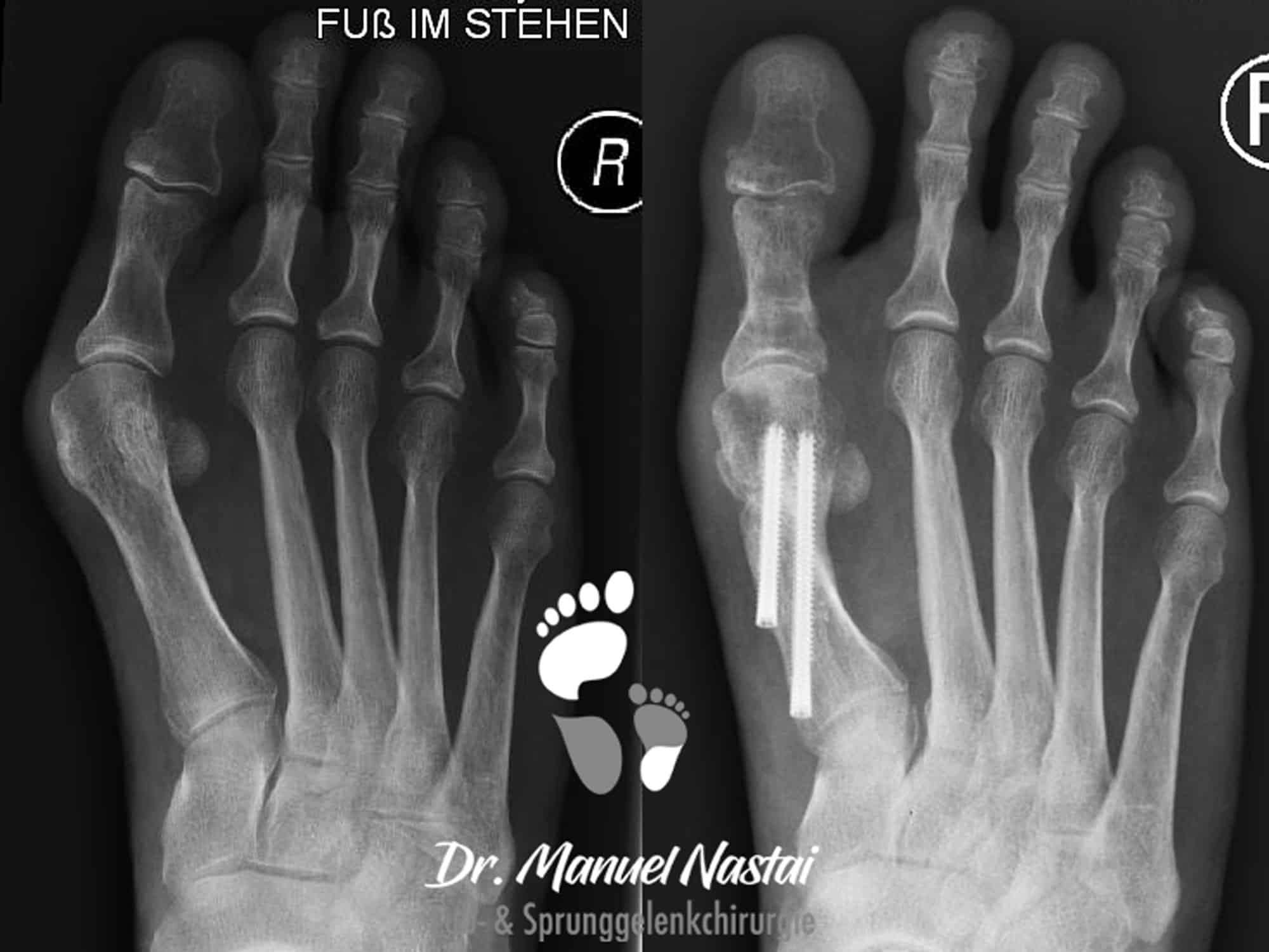 Röntgen-Aufnahme vorher-nachher bei MICA