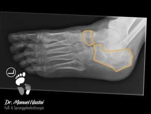 Röntgen Fuß schräg Normalbefund