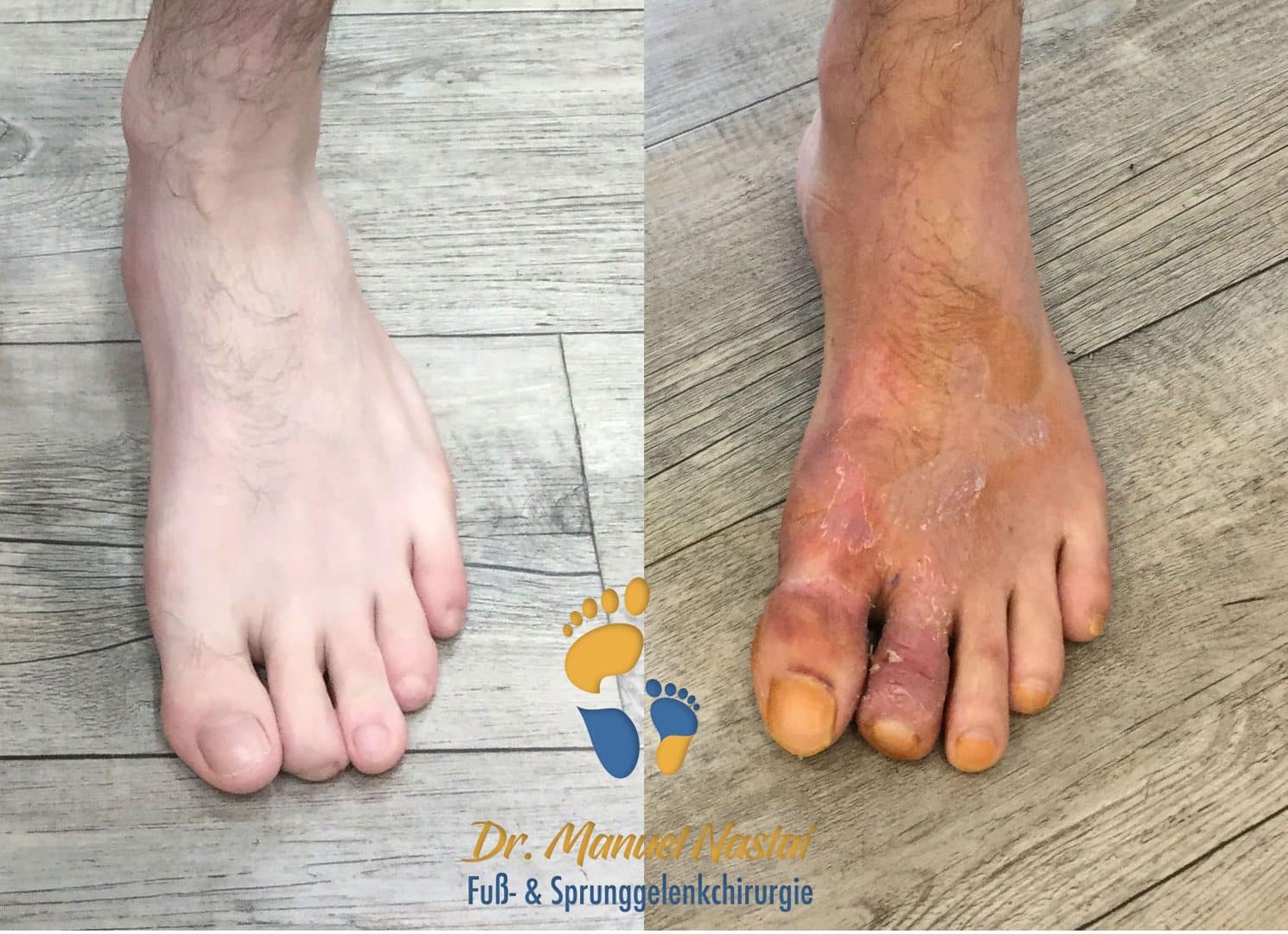 Mallet toeKorrektur Dr.medic Manuel Nastai