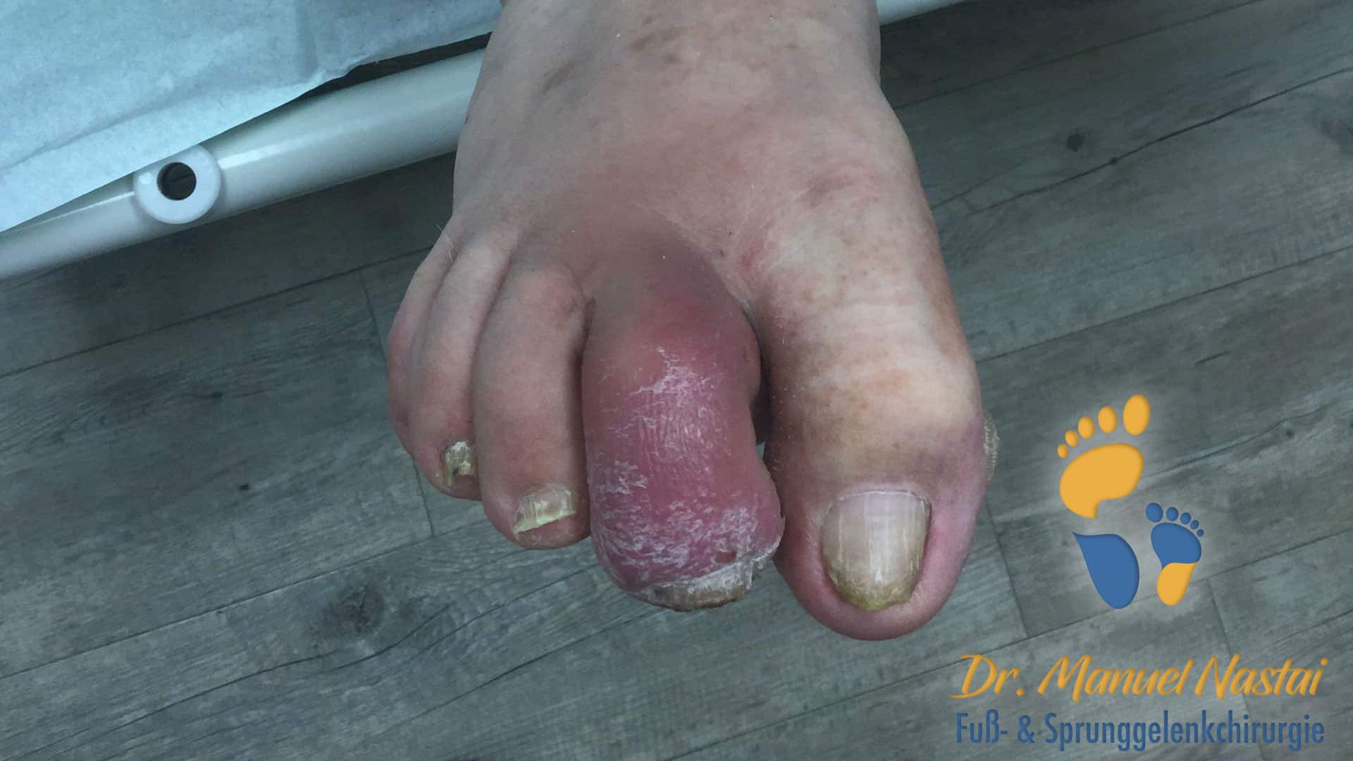 Zehenphlegmone bei diabetischem Fuß
