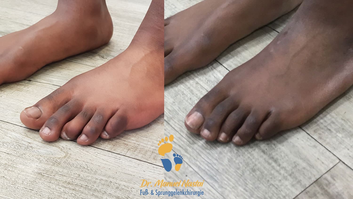 Curly toe Korrektur