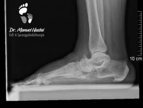 Röntgen-Aufnahme Talonavicular-Arthrose