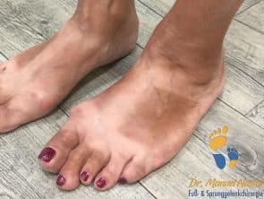 Hallux valgus präoperativ von der Außenseite