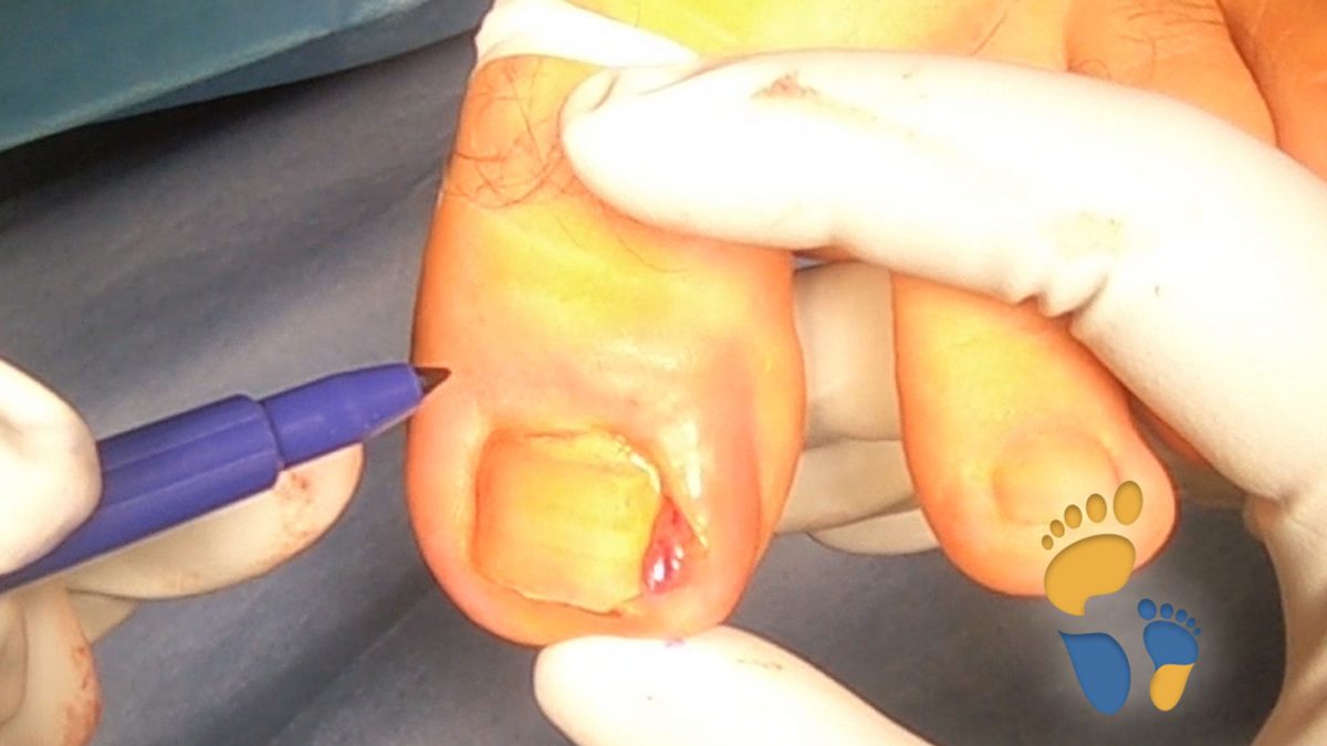 Wildes fleisch nagelbettentzündung Eingewachsener Zehennagel