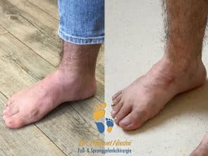 Pes adductus-Korrektur vorher-nachher
