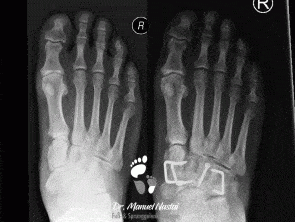 Ergebnis nach Arthrodese des Naviculo-cuneiforme Gelenkes