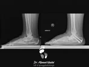 Ergebnis nach tripler tarsaler Arthrodese