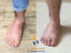 Pes adductus-Korrektur vorher-nachher