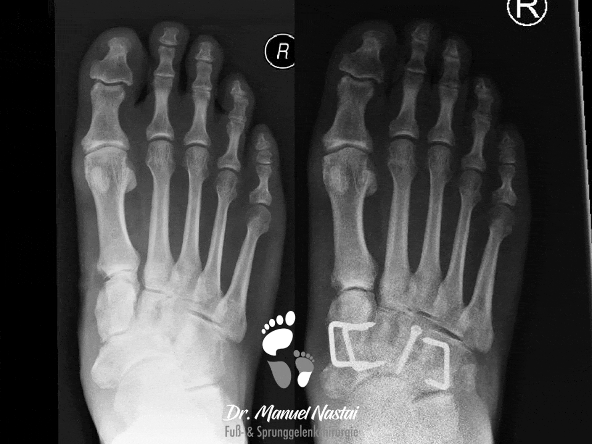 Ergebnis nach Arthrodese des Naviculo-cuneiforme Gelenkes