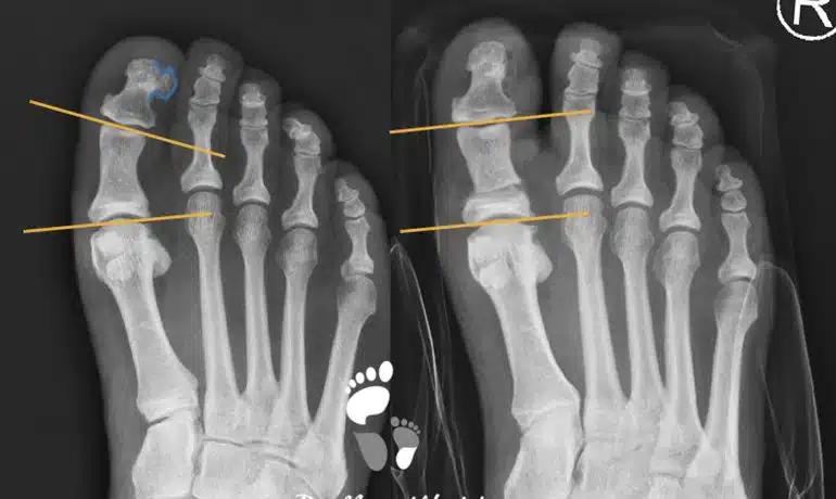 ergebnis nach Akin-Osteotomie und Exostosenabtragung