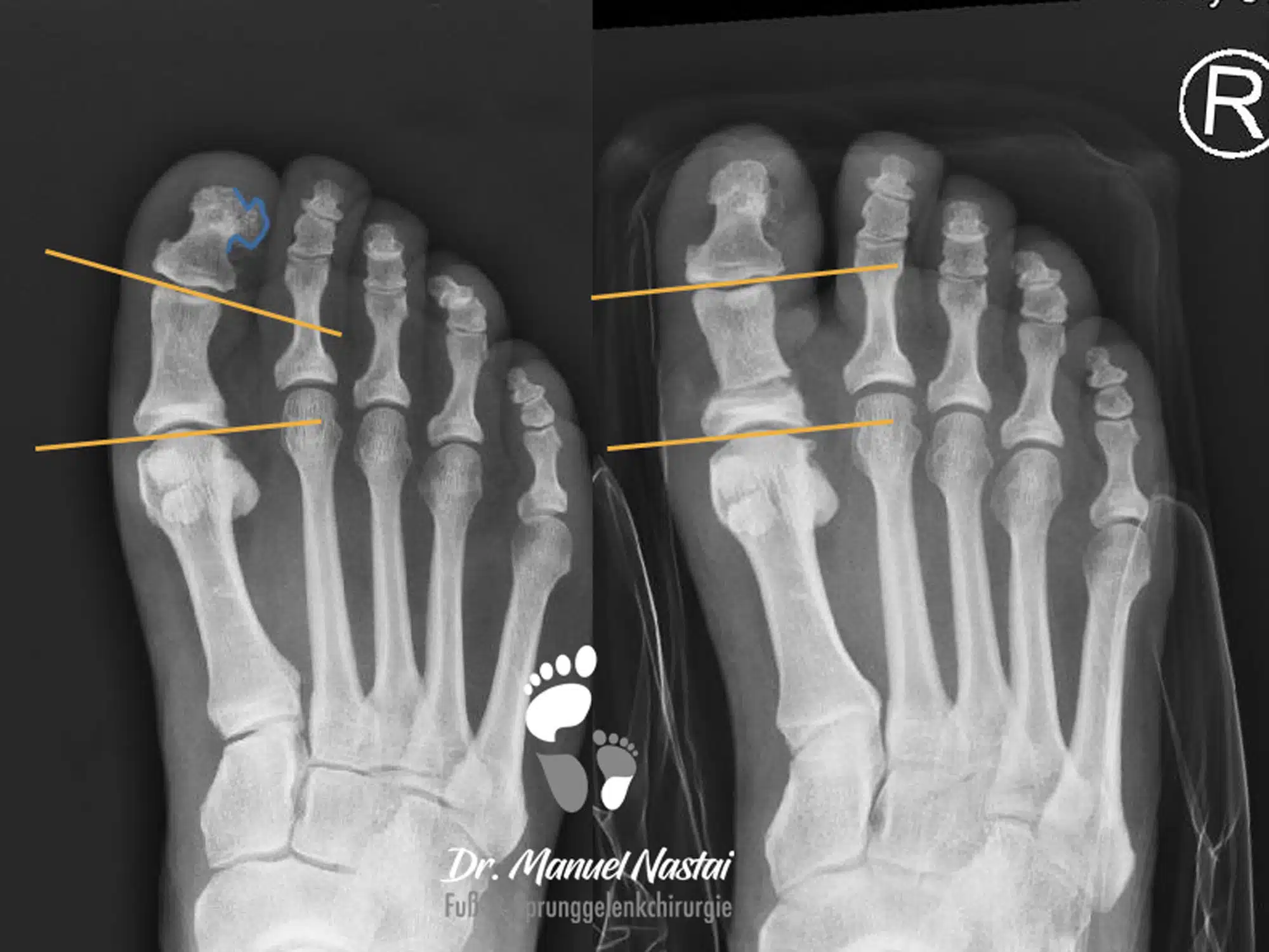 ergebnis nach Akin-Osteotomie und Exostosenabtragung