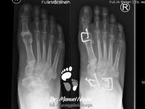 Ergebnis nach tripler tarsaler Arthrodese