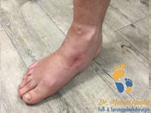Ergebnis nach Arthrodese des Naviculo-cuneiforme Gelenkes