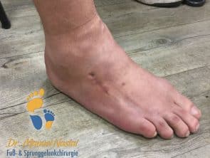Ergebnis nach Arthrodese des Naviculo-cuneiforme Gelenkes