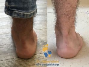 Pes adductus-Korrektur vorher-nachher