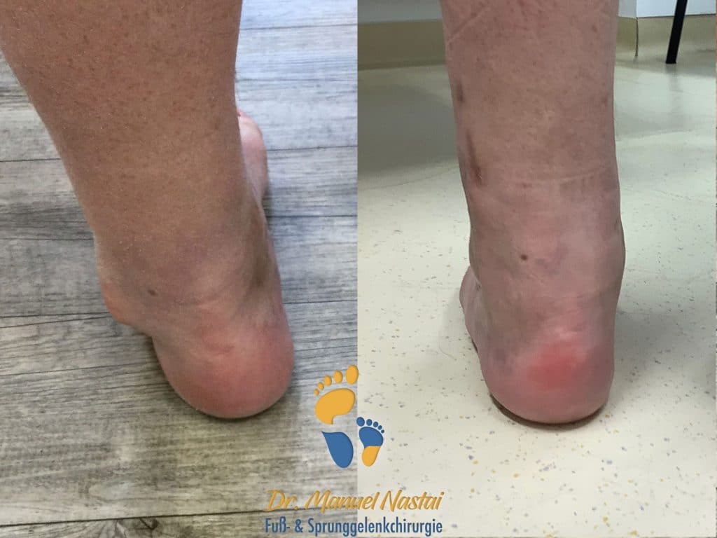 Posttraumatische OSGArthrose Dr.medic Manuel Nastai