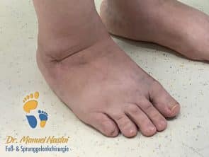 Ergebnis nach tripler tarsaler Arthrodese