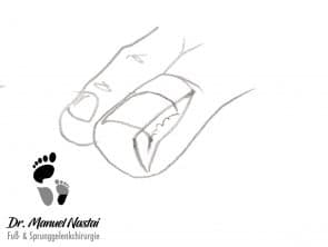 Schnittführung bei Emmert-Plastik