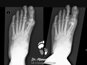 Röntgen-Aufnahmen vorher-nachher Chevron-Osteotomie