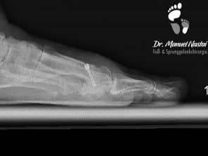 Röntgen-Aufnahmen vorher-nachher Chevron-Osteotomie