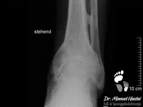 Röntgen-Aufnahme mit OSG-Arthrose