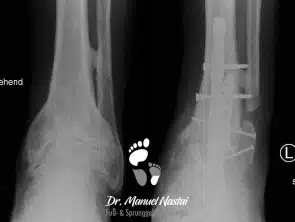 Ergebnis nach OSG-USG-Arthrodese mit retrogradem Nagel