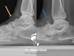 Talonavicular-Arthrose