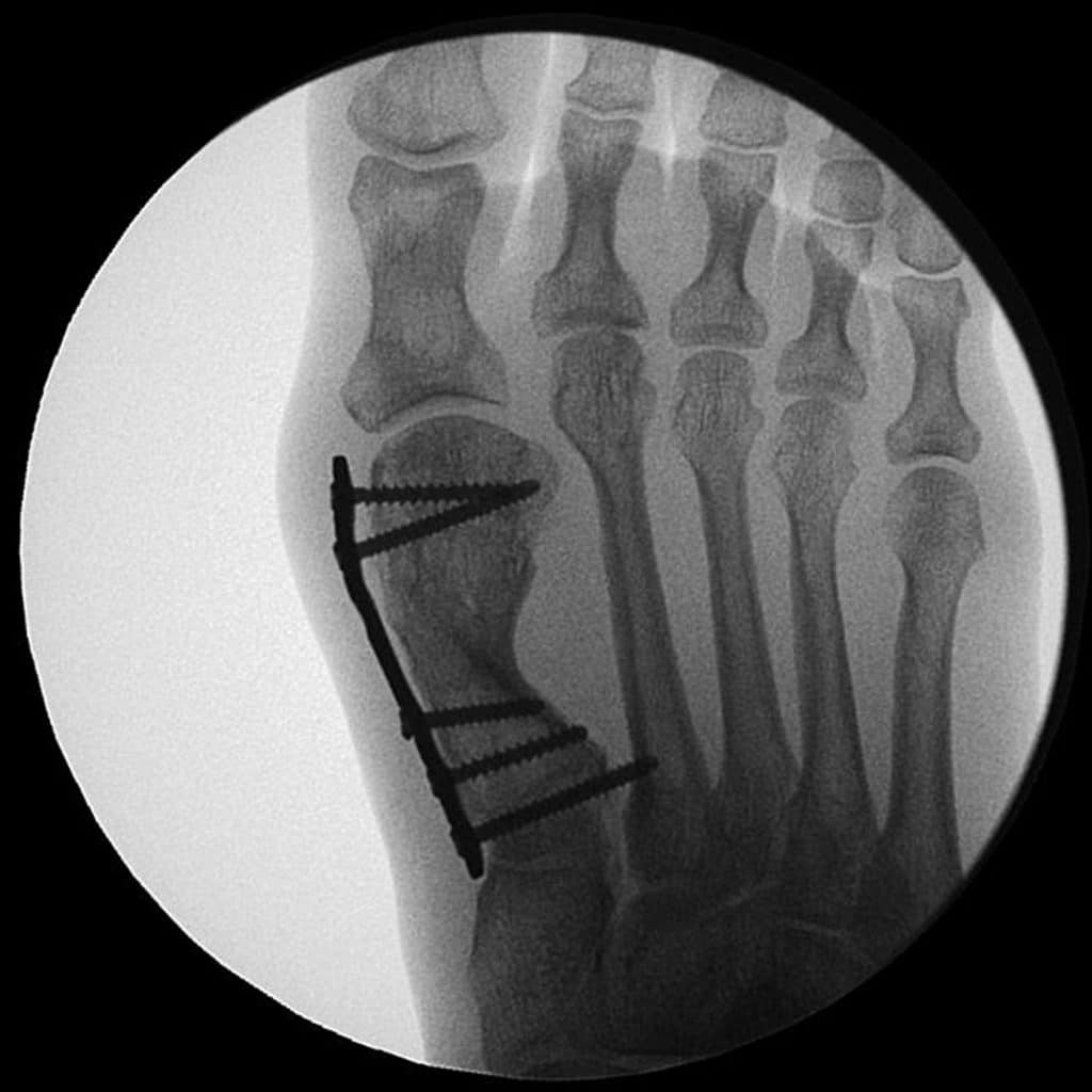 tansfermetatarsalgie nach Hallux valgus Korrektur