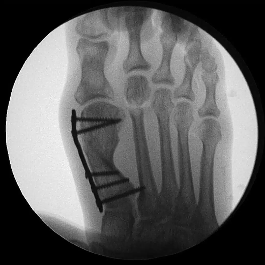 Kontrolle der kompletten Osteotomie bei DMMO