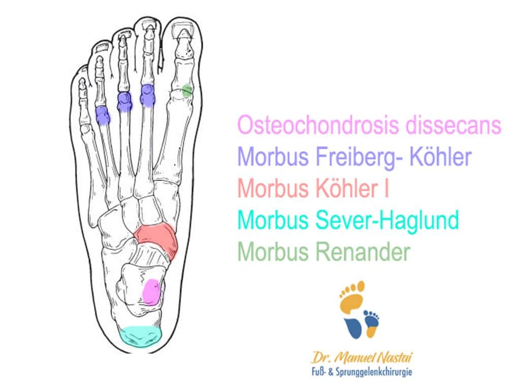 Aseptische knochennekrosen am Fuß