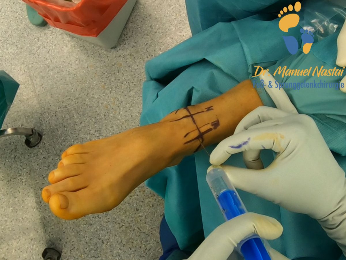 Arthroskopie des Sprunggelenks - Dr.-medic Manuel Nastai