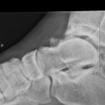 Impingement syndrom OSG