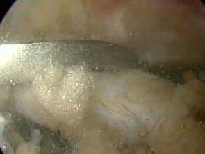 Arthroskopische Resektion Os trigonum