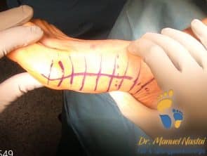 inzision bei Lapidus-Arthrodese