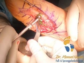 Anlage der plantaren Platte bei Lapidus-Arthrodese