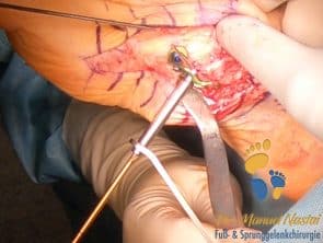 Platzierung der kompressionsschraube bei Lapidus-Arthrodese