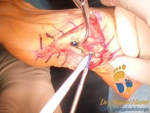 Winkelstabile Fixierung bei Lapidus-Arthrodese
