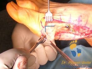 Kapsulotomie bei Hallux valgus Korrektur
