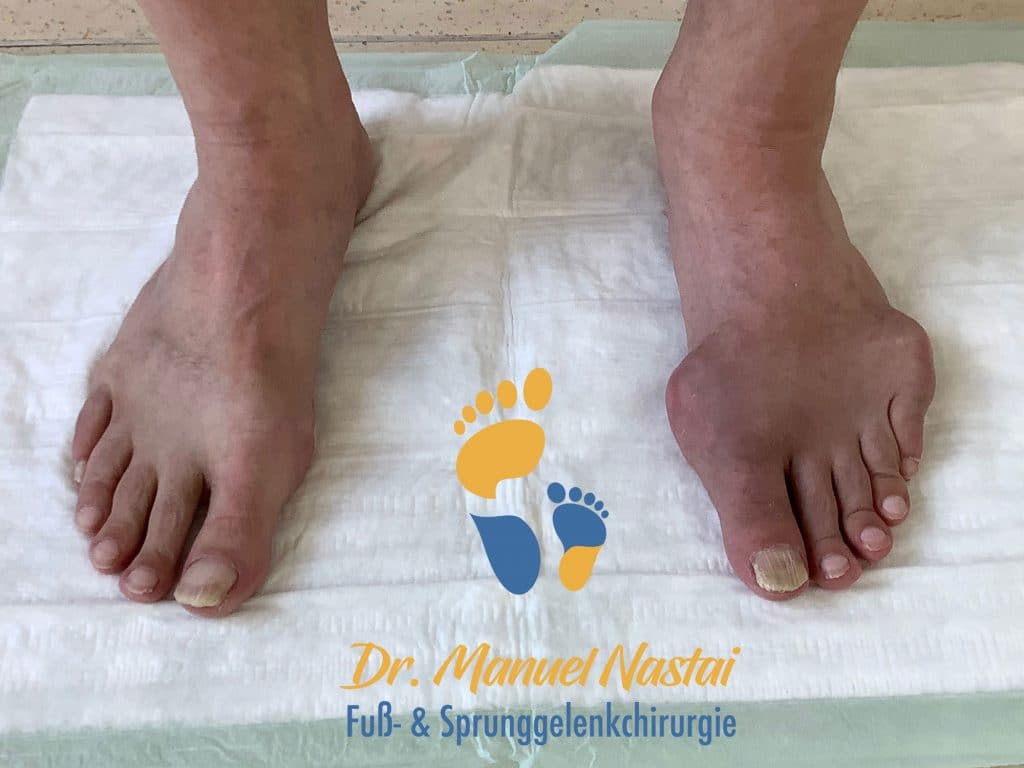 Behandlung Bei Gicht Im Zeh www.drnastai.de