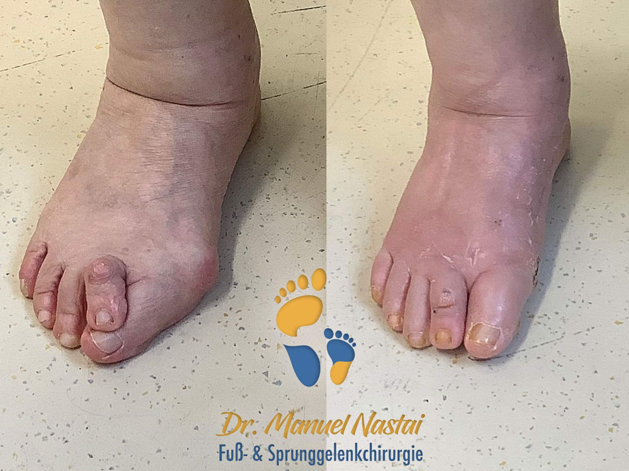 Ergebnis nach Lapidus-Arthrodese und minimalinvasive Reiterzehenkorrektur (postoperative Fotos)