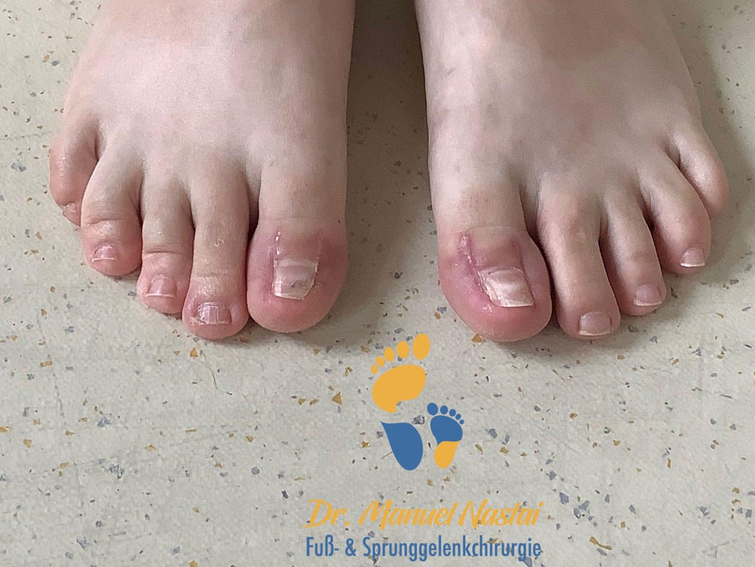Nach 2 Woche Emmert Plastik www.drnastai.de