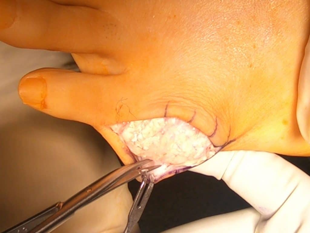 Intraoperative Aufnahme eines Gichttophus