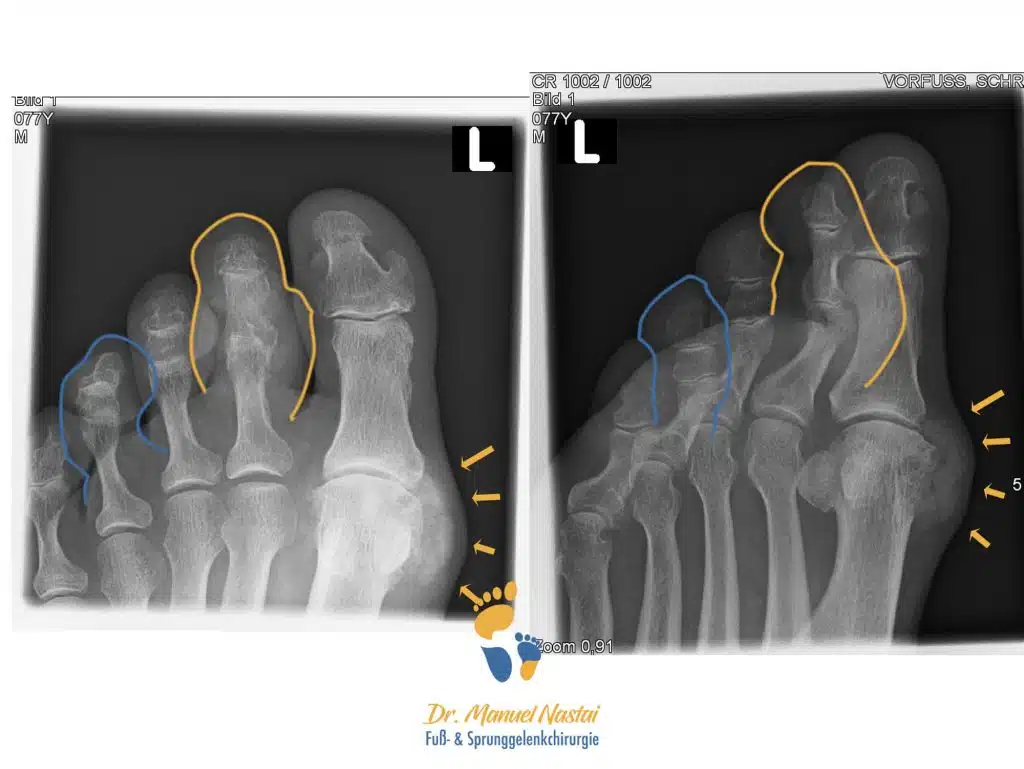 Röntgen-Aufnahme des Fußes bei Gicht