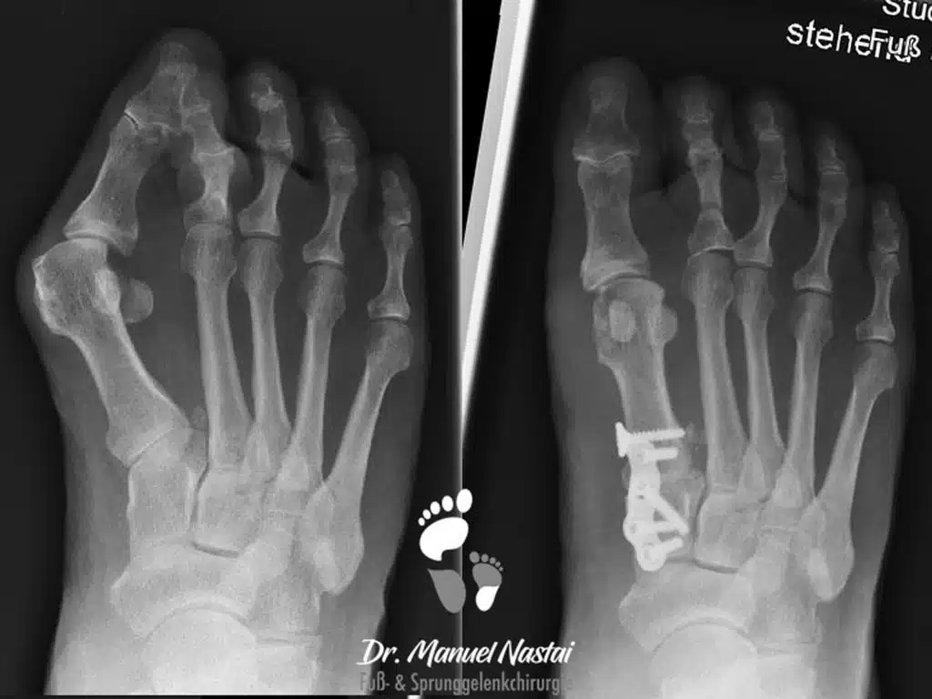 Ergebnis nach Lapidus Arthrodese und minimalinvasiver Reiterzehenkorrektur