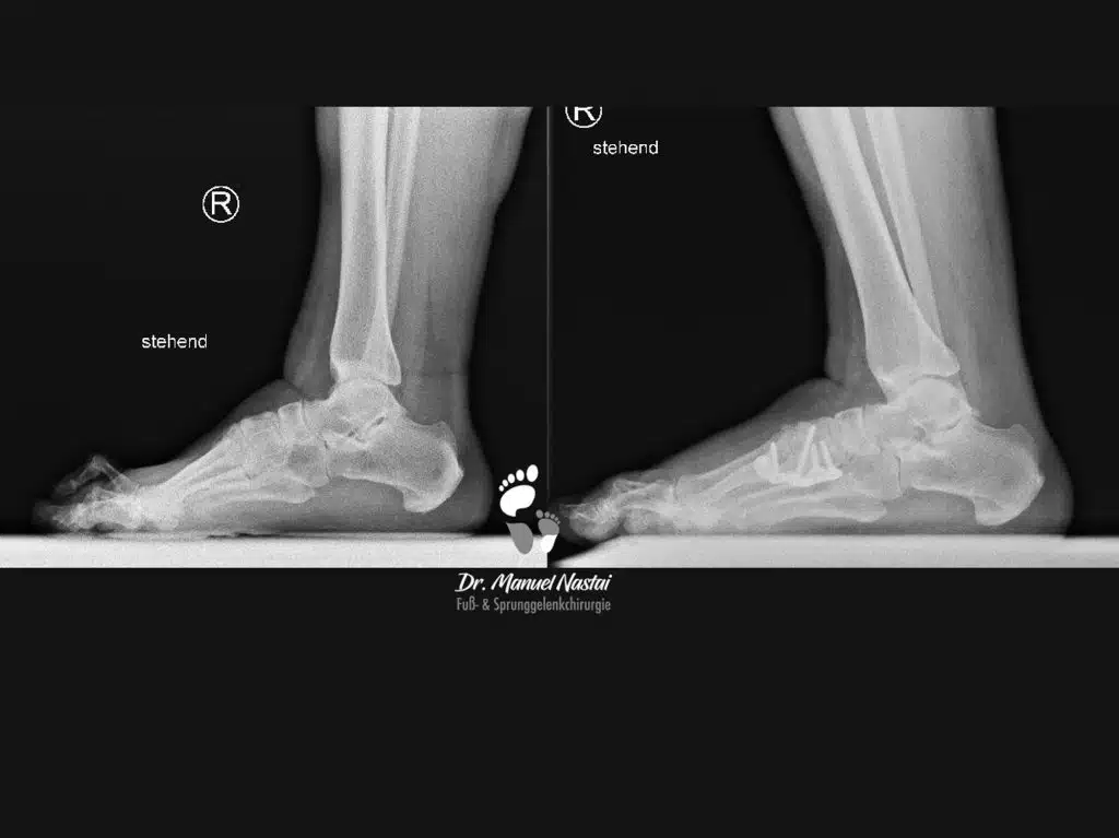 Ergebnis nach Lapidus Arthrodese und minimalinvasiver Reiterzehenkorrektur