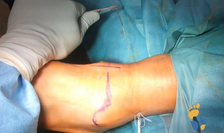 Syndesmosenstabilisierung mit Tight rope (intraoperative Fotos)