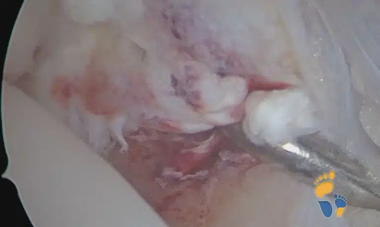 OSG Arthroskopie bei Syndesmosenruptur