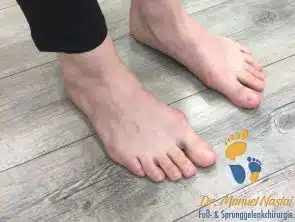 Hallux valgus präoperativ