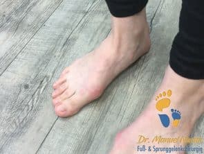Ballenzehe mir Druckstelle bei Schuhkonflikt